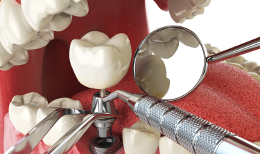 Dental Implants Are Effective, But Are They Safe? What The Latest Research Says