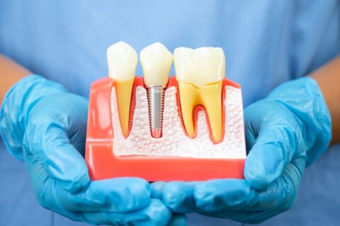 Dental Implants Boynton Beach
