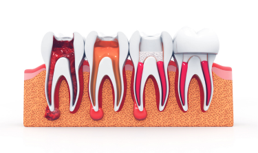 How Root Canal Treatment Can Relieve Tooth Pain and Discomfort?