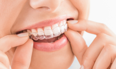 How To Speed Up Your Invisalign Treatment: Tips For Faster Results