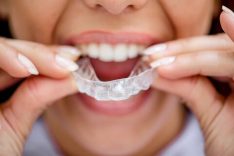 Invisalign Dentist Boynton Beach