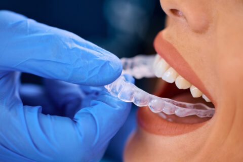Invisalign dentist in Boynton Beach