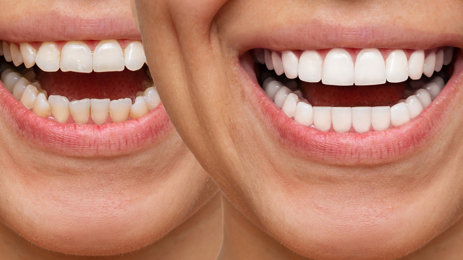 After Getting Dental Veneers: 10 Lifestyle Adjustments to Keep Your Smile Picture-Perfect