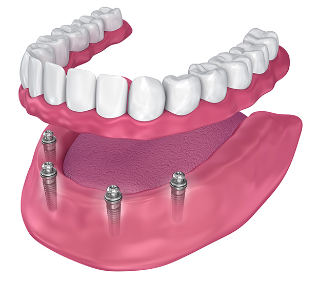 Boynton Beach All-on-4 Implants