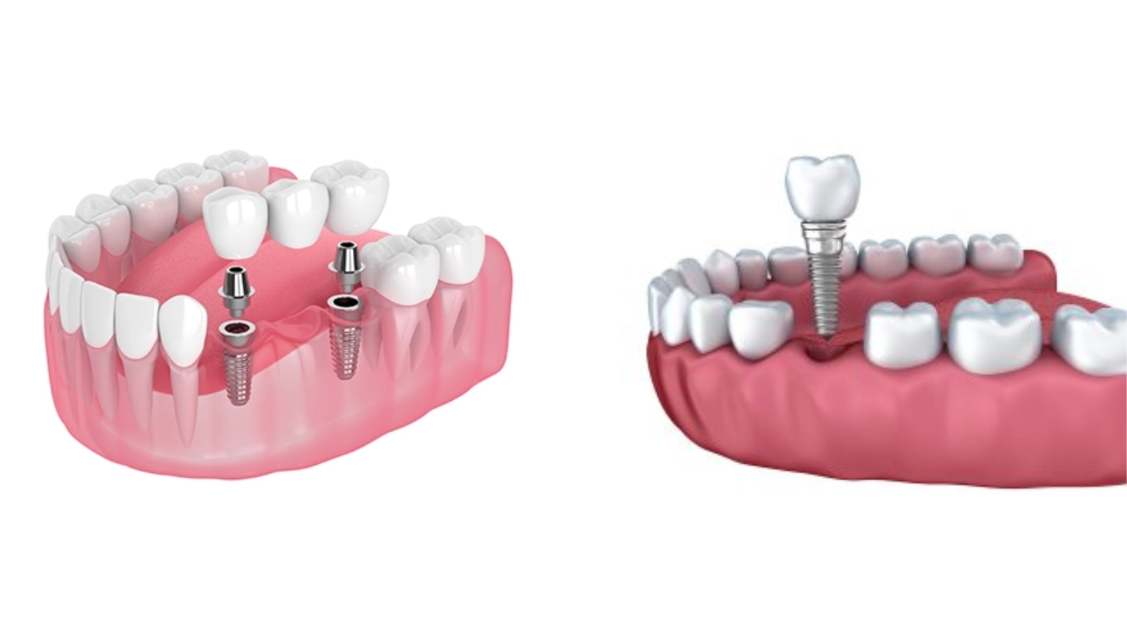 Dental Implants or Bridges: Which Restores the Feel of Natural Teeth Best
