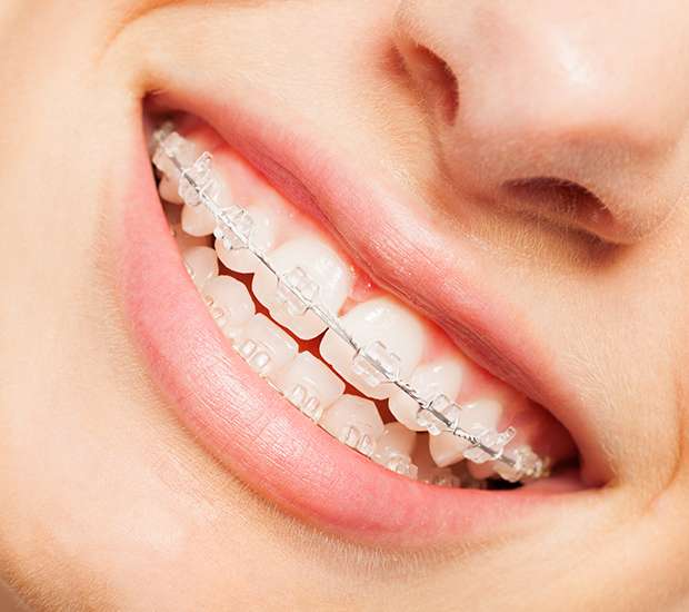 Boynton Beach Clear Braces