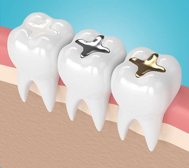 Boynton Beach Composite Fillings