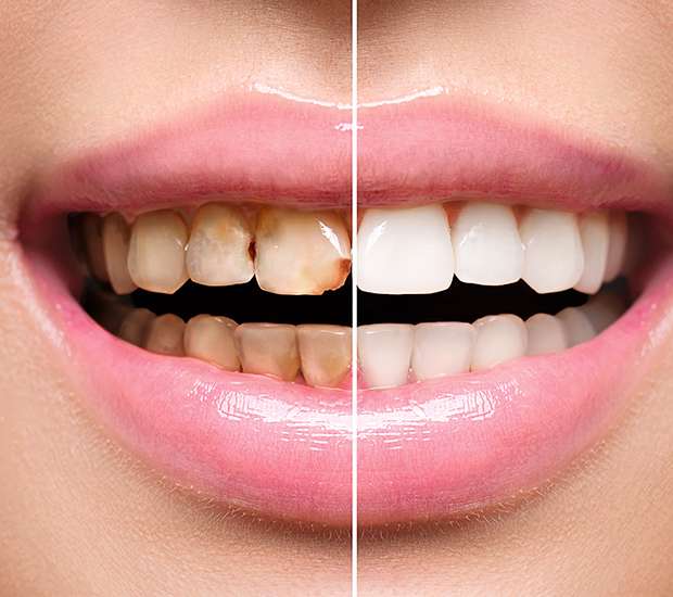 Boynton Beach Dental Implant Restoration