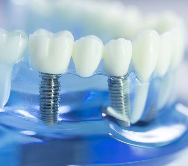 Boynton Beach Dental Implants