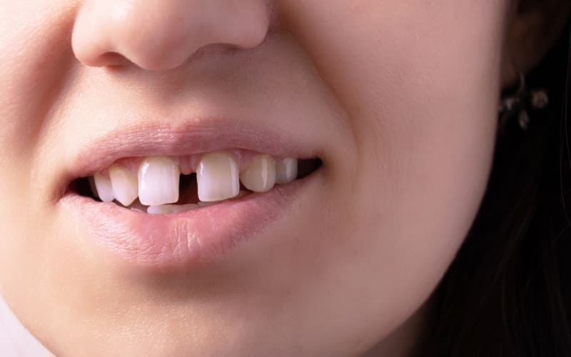 How To Fill Gaps Between Teeth?