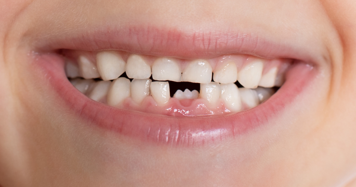 how to fix a cracked tooth naturally