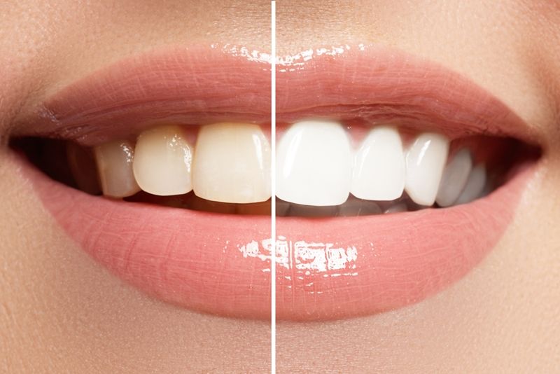 Boynton Beach Teeth Whitening
