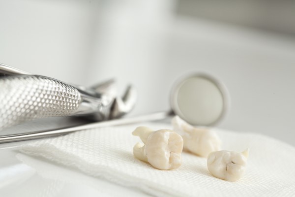 When A Tooth Extraction May Be Recommended