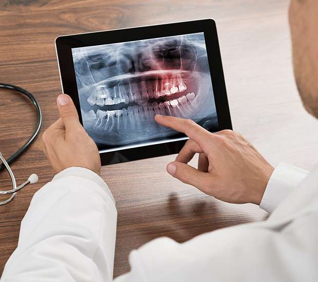 Boynton Beach Types of Dental Root Fractures