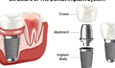 Why Dental Implants In Boynton Beach Are Life Changing For Your Smile?